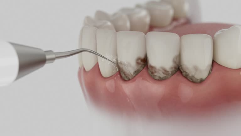 Reliable Dental Implants contractor in Dunellen, NJ by Smile Center Dentistry